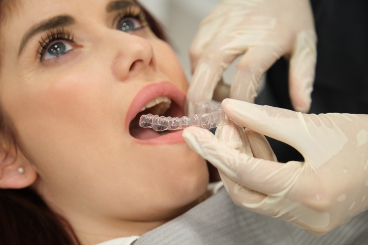 Clear aligner placement at Smiles of Anderson for Invisalign treatment in Anderson, IN.