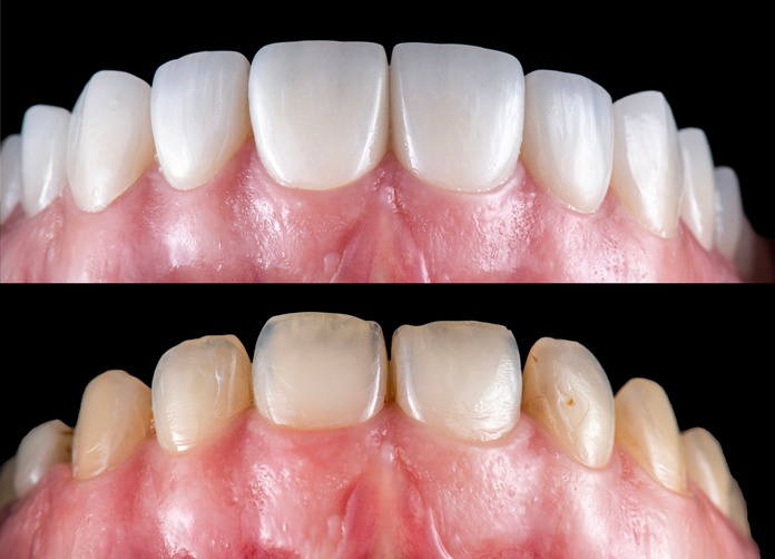 Image showing before and after effects of dental veneers on front teeth in Anderson, IN